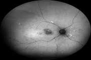 Pachychoroid neovasculopathy versus macular neovascularization in age-related macular degeneration with and without shallow irregular pigment epithelial detachment